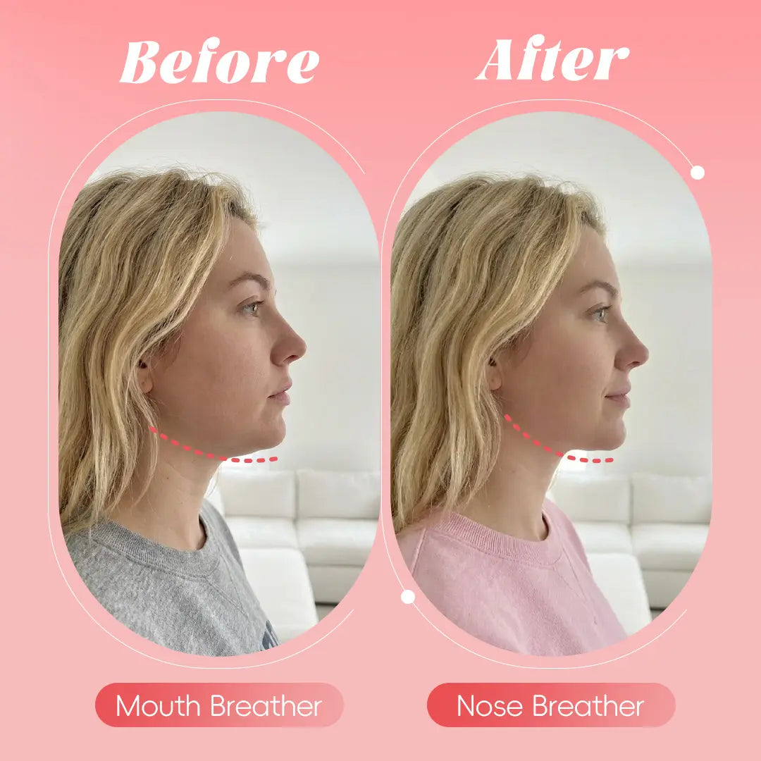 Before and after — mouth breather vs nose breather
